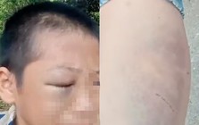 Xôn xao clip bé trai mắt bầm tím, khóc kêu cứu vì nhiều lần bị đánh đập khi ở cùng bố và vợ mới