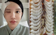 Người phụ nữ bị ký sinh trùng bò vào hốc mắt, suýt mù, bác sĩ cảnh báo 1 thói quen nhiều người Việt mắc phải