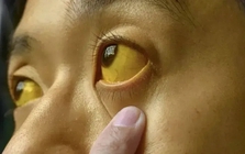 Nếu mắt có 6 thứ, đi khám ung thư ngay còn kịp!