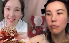 Mặt cô gái trẻ biến dạng sau 2 năm làm mukbang, bác sĩ cảnh báo 4 cái giá phải trả về sức khỏe ít ai biết đến