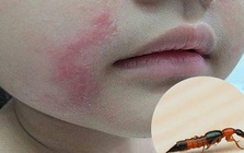 Bác sĩ BV Bạch Mai cảnh báo căn bệnh viêm da do một loại côn trùng gây ra: Cực độc, rất dễ nhầm lẫn với bệnh Zona và gặp nhiều vào mùa hè