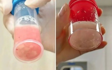 Cô bé 12 tuổi phổi trắng xóa và đông đặc sau 1 ngày bị sốt, bác sĩ cảnh báo: Đừng lúc nào cũng tưởng con cảm lạnh!