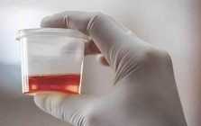 Bé trai 7 tuổi dập thận, tiểu ra máu sau khi chơi đùa với bạn trên lớp: Phó Giám đốc Bệnh viện Nhi Đồng 2 cảnh báo!