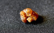 Bác sĩ Bệnh viện Bạch Mai chỉ ra cách ăn uống giảm nguy cơ hình thành sỏi thận