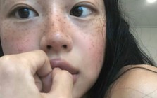 Bác sĩ chuyên khoa thận cay đắng thừa nhận: Dấu hiệu nguy hiểm nhất của suy thận không phải đau lưng dưới, mà là…