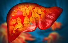 Gan có thể tổn thương tới 60-70% mới lộ dấu hiệu: 8 biểu hiện nhiều người vẫn tưởng bệnh vặt