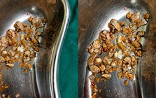 Nam kỹ sư 35 tuổi nhập viện vì sỏi chất đầy thận sau khi bỏ trà sữa, uống thứ nước lành mạnh để giảm cân
