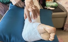 Xem nhẹ nốt ruồi ở nơi cực hiếm ai để ý, người phụ nữ "hối không kịp" vì ung thư đã di căn