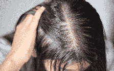 Tưởng stress vì thi cử nên rụng tóc, cô gái 22 tuổi phát hiện căn bệnh đang âm thầm đang phá hủy thận