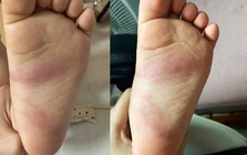 Hưng Yên: Xác minh phản ánh trẻ 3 tuổi bị bầm tím chân sau khi ở trường mầm non về