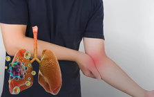 Ung thư phổi thường được chẩn đoán ở giai đoạn muộn: Nếu cảm thấy "1 chỗ sần sùi, 1 chỗ tê bì và 2 cơn đau", hãy đi khám sớm