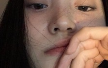 5 vị trí mọc mụn trên mặt đang "tố cáo” nhiều vấn đề sức khỏe ở tim, gan, phổi, dạ dày