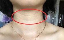 Một khi 3 hiện tượng này xuất hiện trên cổ bạn: Đừng bất cẩn, nên đi khám ngay