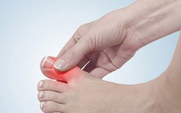 Phương pháp giảm đau nhanh nhất khi ngón chân cái bị sưng tấy