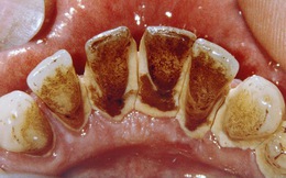 Đừng để bệnh răng miệng tăng nguy cơ ung thư: 4 cách đánh bật cao răng tại nhà