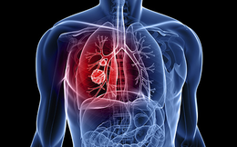Dấu hiệu cảnh báo ung thư phổi đang “sống” trong cơ thể: Nhận biết sớm cơ hội sống lên tới 55%