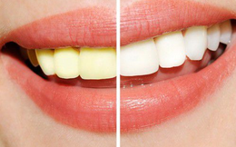 Chuyên gia nha khoa chỉ ra các nguyên nhân "không ngờ" khiến răng ố vàng và biện pháp tẩy trắng răng hiệu quả
