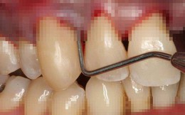 90% người Việt sâu răng, viêm lợi, mất răng... do thói quen sai lầm này: Bạn có mắc phải?
