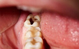 Răng số 8 - răng khôn mọc... dại: Khi nào cần nhổ, nhổ có nguy hiểm không?