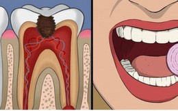 11 cách giúp bạn dịu cơn đau do mọc răng khôn