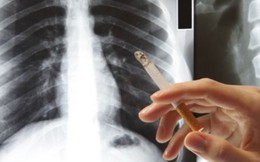 90% người mắc ung thư phổi tử vong trong vòng 1 đến 2 năm vì bỏ qua những dấu hiệu này