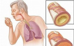 4 cách làm sạch phổi phòng tránh ung thư