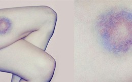 Nếu thấy da dễ bị bầm tím thì hãy cẩn thận, đó có thể là dấu hiệu cảnh báo ung thư máu và loạt căn bệnh khác