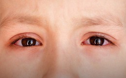 Đau mắt đỏ có thể bùng phát trong mùa hè, muốn phòng bệnh hãy làm đủ 5 việc này mỗi ngày