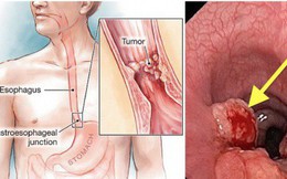 Bị ung thư lại tưởng viêm họng: 3 dấu hiệu điển hình cần nhớ, ai có cần đi khám sớm