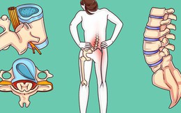 Bác sĩ phẫu thuật tiết lộ bài tập có thể giúp cột sống, thắt lưng của bạn khỏe mạnh trước khi mọi chuyện tồi tệ xảy ra