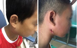 Một bệnh viện ở Nghệ An công bố 3 trẻ nhiễm bệnh Whitmore "ăn thịt người": Cảnh báo dấu hiệu dễ nhầm lẫn với bệnh quai bị