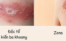 Phân biệt vết thương do kiến ba khoang với viêm da do zona để tránh dùng sai thuốc khiến bệnh càng khó chữa