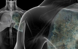 WebMD "chỉ mặt" thủ phạm gây ra 9/10 ca tử vong do ung thư phổi: Cần từ bỏ và tránh xa!