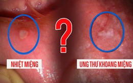 Bác sĩ chuyên khoa cảnh báo bệnh viêm loét miệng tái phát nhiều lần: Khi nào là dấu hiệu của ung thư?