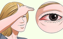 Vì sao mắt cứ bị đỏ ngầu sau khi tỉnh dậy? Đó cũng là cảnh báo sức khoẻ bạn cần chú ý