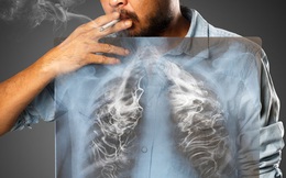 Mỗi năm TQ có 780.000 người mắc ung thư phổi: BS khuyên 3 việc không nên làm trước khi ngủ