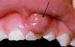 Nghiên cứu mới gây "sốc": Không đánh răng có thể gây ung thư!