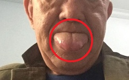 Người đàn ông phải cắt bỏ 1/3 lưỡi do mắc ung thư lưỡi: 2 việc làm xấu nhiều người mắc phải có thể gây ra tình trạng này