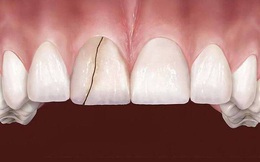 6 dấu hiệu điển hình cảnh báo nguy cơ lão hóa răng sớm mà nhiều người chẳng ngờ đến