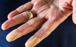 Soi tay chân cũng có thể nhận biết được 5 biểu hiện cảnh báo bạn có nguy cơ mắc ung thư hay không