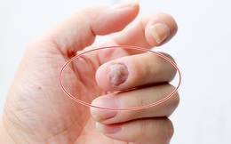4 thay đổi trên bàn tay cho thấy lá gan của bạn đang "cầu cứu", phát hiện sớm có thể điều trị hiệu quả