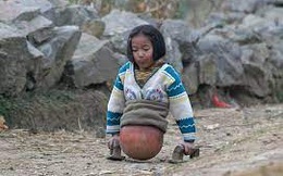 “Cô bé bóng rổ” mất nửa người vẫn lạc quan khiến thế giới cảm phục 15 năm trước: Kinh ngạc với cuộc sống thay đổi hoàn toàn ở hiện tại