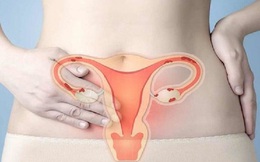 Ung thư cổ tử cung gây tử vong cao thứ 3 ở phụ nữ: Dấu hiệu cảnh báo, người có nguy cơ cao mắc phải và các giai đoạn phát triển bệnh