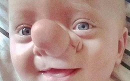 "Cậu bé Pinocchio đời thực” sinh ra với chiếc mũi to dị dạng khiến bố mẹ cũng sốc, gây bất ngờ với diện mạo sau ít năm