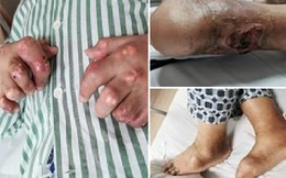 Chàng trai 27 tuổi bị thối chân, biến dạng khớp, bàn tay phủ đầy hạt tophi vì loại nước uống yêu thích của nhiều người