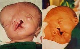 Bé trai sinh ra với 2 khuôn mặt dính liền nhau, bác sĩ khẳng định khó sống sót nhưng diện mạo và cuộc sống sau 17 năm gây kinh ngạc