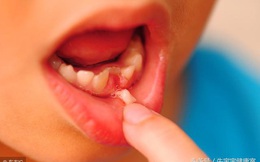 3 dấu hiệu bất thường trong khoang miệng ngầm cảnh báo bệnh ung thư lưỡi đang tiến triển