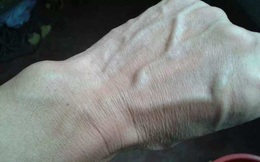 Người gan kém thường có 3 thay đổi bất thường ở bàn tay, đi khám ngay vì rất dễ là dấu hiệu của ung thư gan