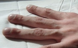 4 triệu chứng trên ngón tay cho thấy chất độc trong cơ thể gần như bùng phát, hãy nhanh chóng đi tầm soát ung thư gan, phổi trước khi quá muộn