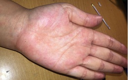 Người có gan kém thường có 4 biểu hiện bất thường ở bàn tay, nếu không có thì gan vẫn rất khỏe mạnh